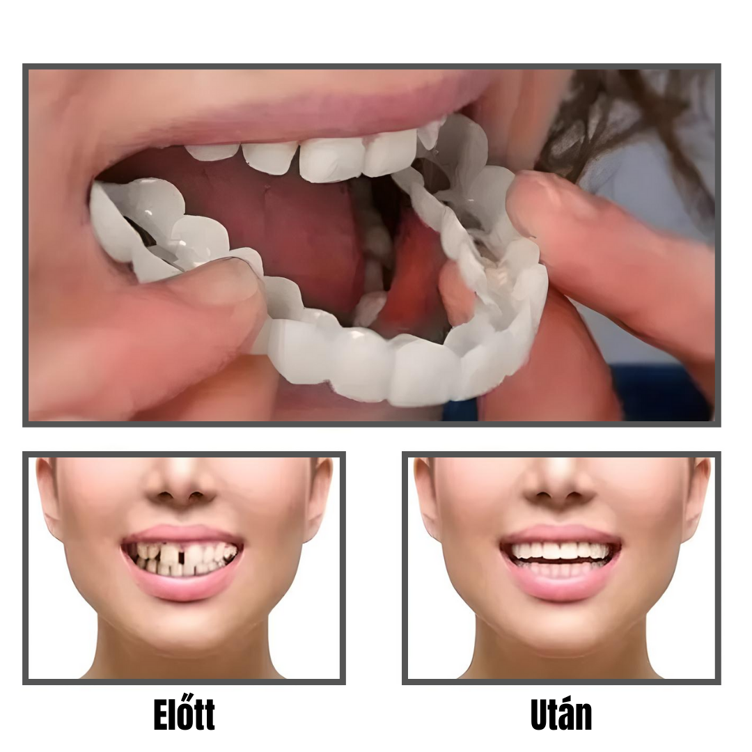 1+1 INGYEN! InstantSmile™ PRO Készlet: Hypoallergén és orvosi minőségű megoldás a 2 évig tartó ragyogó mosolyért – Spóroljon százezreket a fogorvoson, és tüntesse el a hiányzó vagy sárga fogakat azonnal!