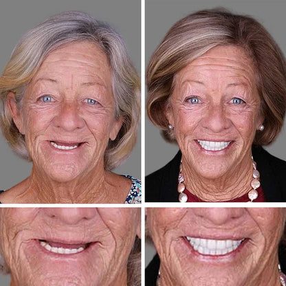 1+1 INGYEN! InstantSmile™ PRO Készlet: Hypoallergén és orvosi minőségű megoldás a 2 évig tartó ragyogó mosolyért – Spóroljon százezreket a fogorvoson, és tüntesse el a hiányzó vagy sárga fogakat azonnal!