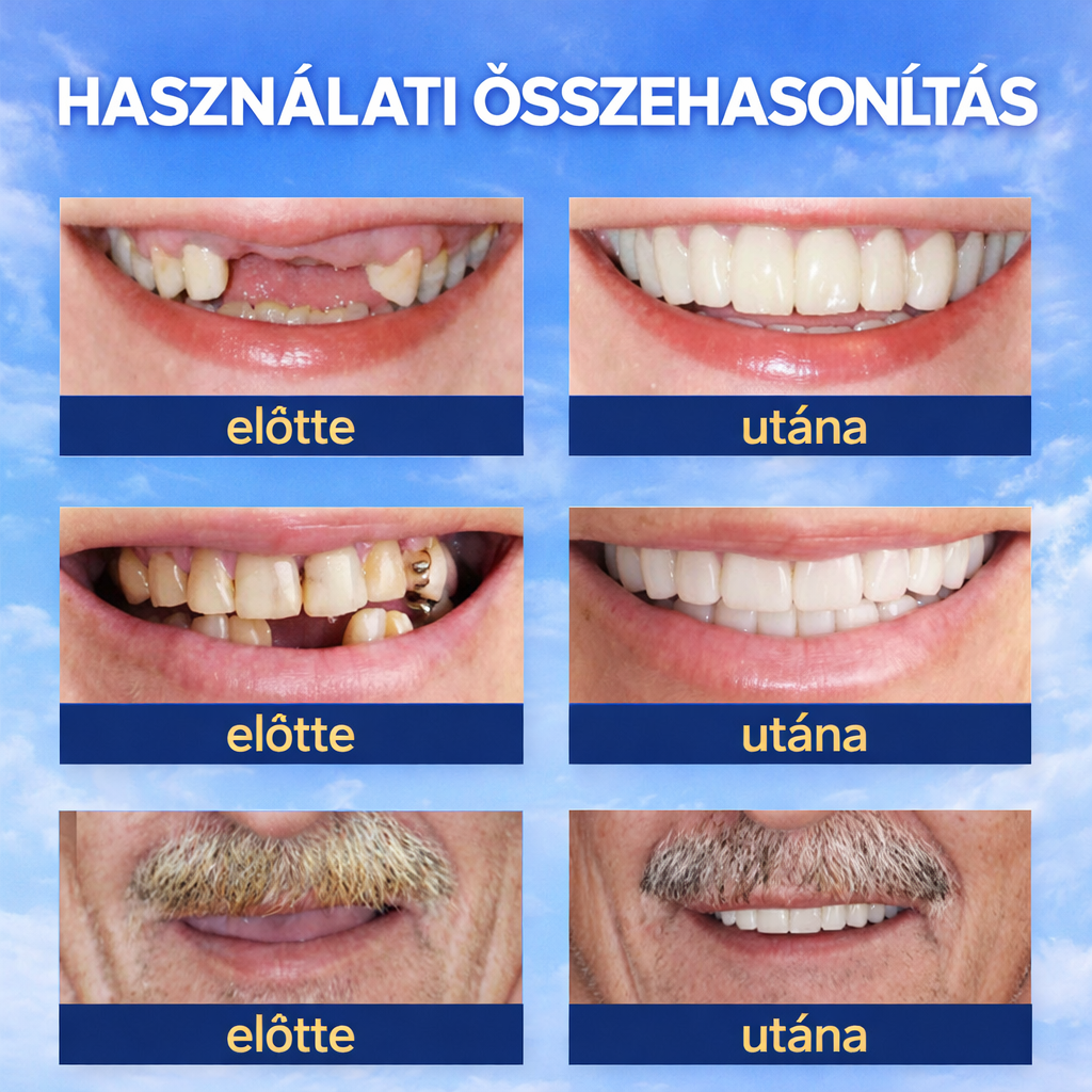 1+1 INGYEN! InstantSmile™ PRO Készlet: Hypoallergén és orvosi minőségű megoldás a 2 évig tartó ragyogó mosolyért – Spóroljon százezreket a fogorvoson, és tüntesse el a hiányzó vagy sárga fogakat azonnal!