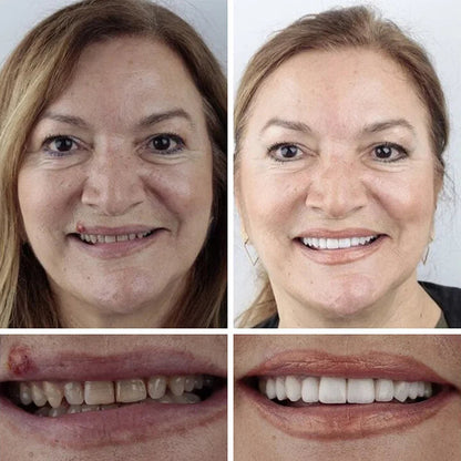 1+1 INGYEN! InstantSmile™ PRO Készlet: Hypoallergén és orvosi minőségű megoldás a 2 évig tartó ragyogó mosolyért – Spóroljon százezreket a fogorvoson, és tüntesse el a hiányzó vagy sárga fogakat azonnal!