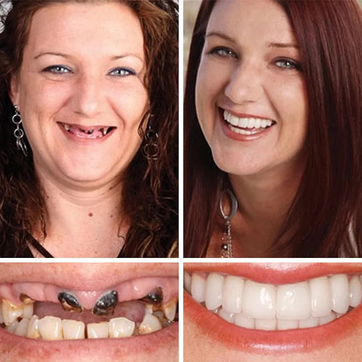 1+1 INGYEN! InstantSmile™ PRO Készlet: Hypoallergén és orvosi minőségű megoldás a 2 évig tartó ragyogó mosolyért – Spóroljon százezreket a fogorvoson, és tüntesse el a hiányzó vagy sárga fogakat azonnal!