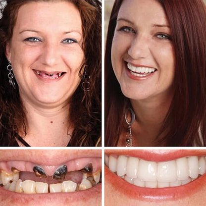 1+1 INGYEN! InstantSmile™ PRO Készlet: Hypoallergén és orvosi minőségű megoldás a 2 évig tartó ragyogó mosolyért – Spóroljon százezreket a fogorvoson, és tüntesse el a hiányzó vagy sárga fogakat azonnal!